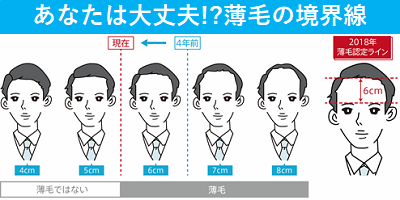 あなたは大丈夫 薄毛の境界線 ミレニアル世代はおでこの広さ6cm以上で薄毛と認識