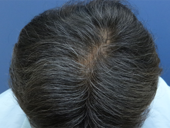 薄毛治療 発毛症例 45歳/O型/8ヶ月後