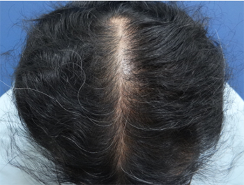 薄毛治療 発毛症例 52歳/O型/8ヶ月後