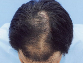 薄毛治療 発毛症例 34歳/MO型/11ヶ月後