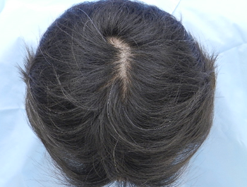 薄毛治療 発毛症例 40歳/O型/5ヶ月後