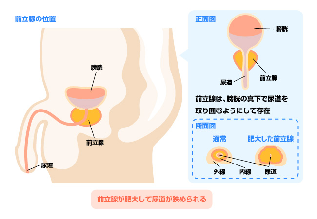 薄毛の人は前立腺肥大に要注意！？