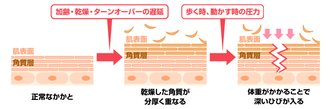 かかとのひび割れは、老化のバロメーター