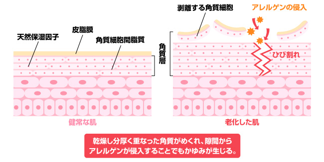 かゆみの原因は乾燥とターンオーバーの乱れ！