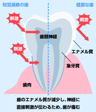 歯痛の原因は？