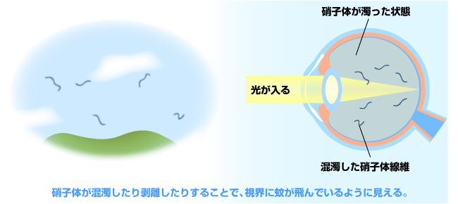 目の老化でゴミが見える？