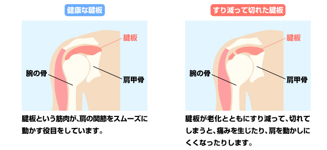 高いものを取ろうとすると肩が痛む