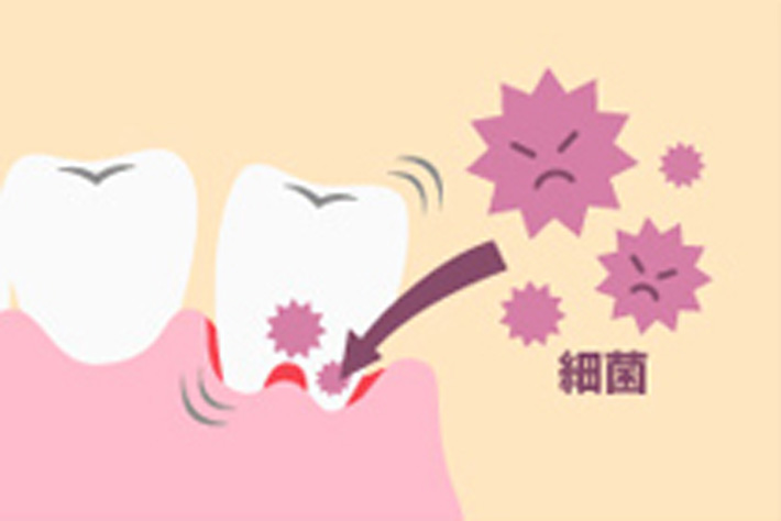 歯磨きで血が出た！ 歯ぐきの出血の原因と対策