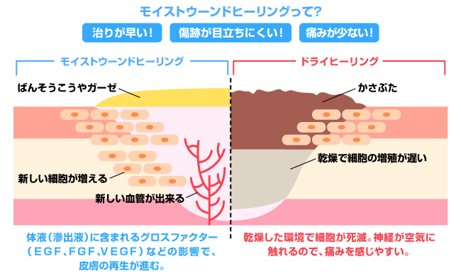 新常識！「かさぶた＝治りかけ」は間違い！？