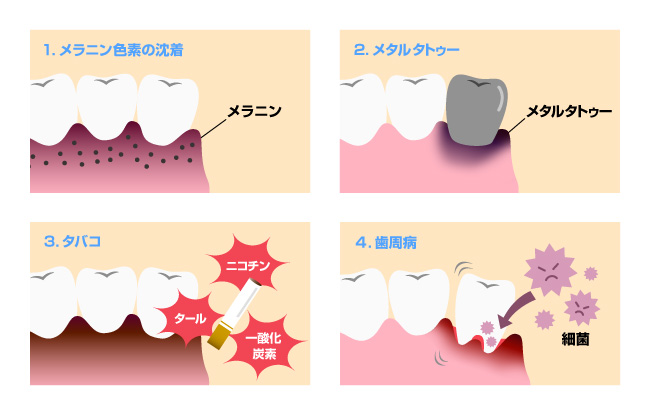 歯茎が黒ずむ４つの原因