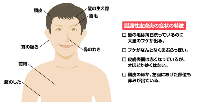 フケ症かと思ったら、皮膚の病気である可能性あり