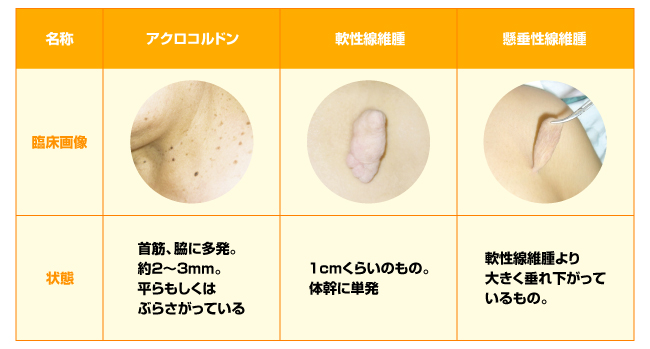 イボは大きさによって3つの名称がある