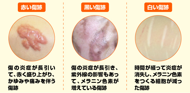 絶対に傷跡を残さない タイプ別のケア法 アンファーからだエイジング 専門ドクター監修