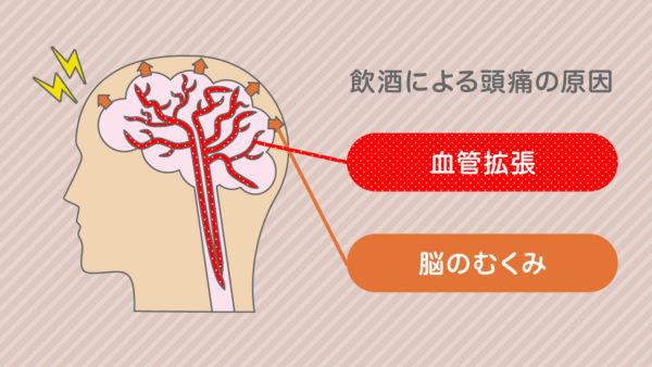 飲酒による頭痛の原因