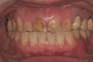 ■酸蝕歯のトラブルが起きた歯の例