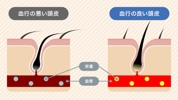 若い薄毛の原因　頭皮の血流が悪化