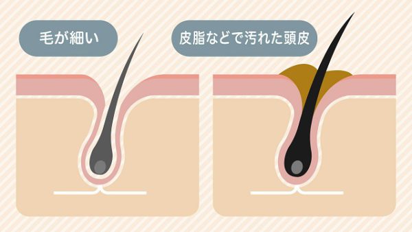 男性ホルモンが増えて抜け毛が多くなった