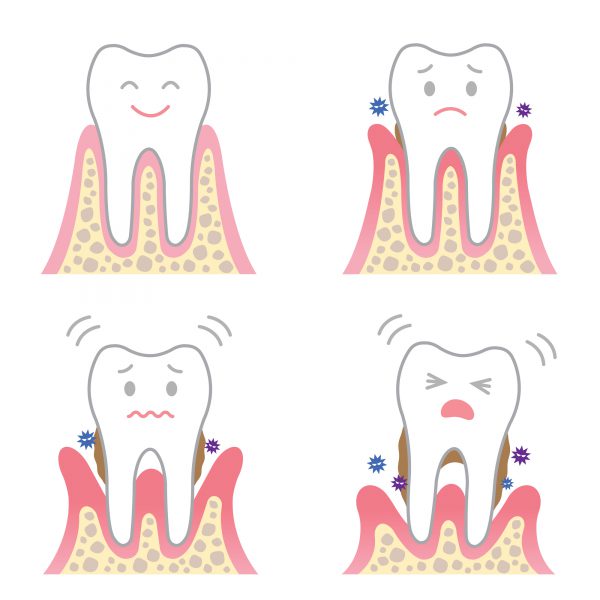 歯周病で歯が抜ける進行過程