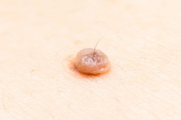 単なる老化から悪性腫瘍まで。イボには4つの種類があった！