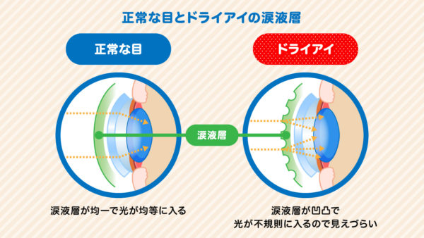 正常な目とドライアイの違い