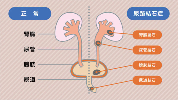 尿路結石とは？ 