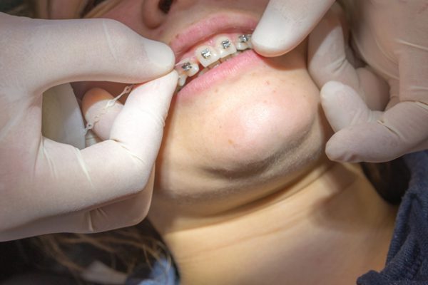 歯並びの矯正にはどのような方法がある？