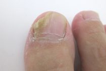 爪水虫の治療法とは？ 足の爪が濁っていたら要注意！