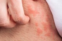 アトピー性皮膚炎を治すために知っておきたい対処＆予防法