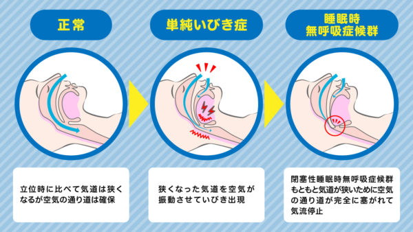 いびきの出る原因と種類