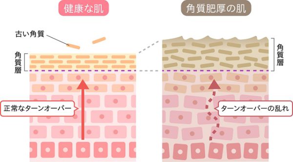 ターンオーバーの乱れが角質を厚くかかとのひび割れにつながる