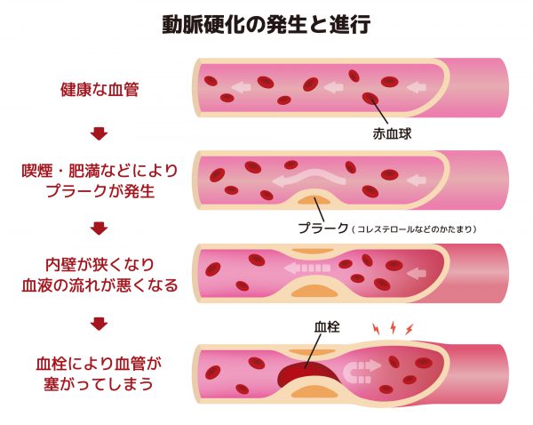 血管に血栓が詰まって動脈硬化が起こる