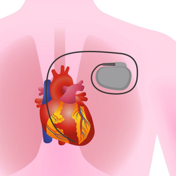 徐脈の不整脈治療に有効なペースメーカー